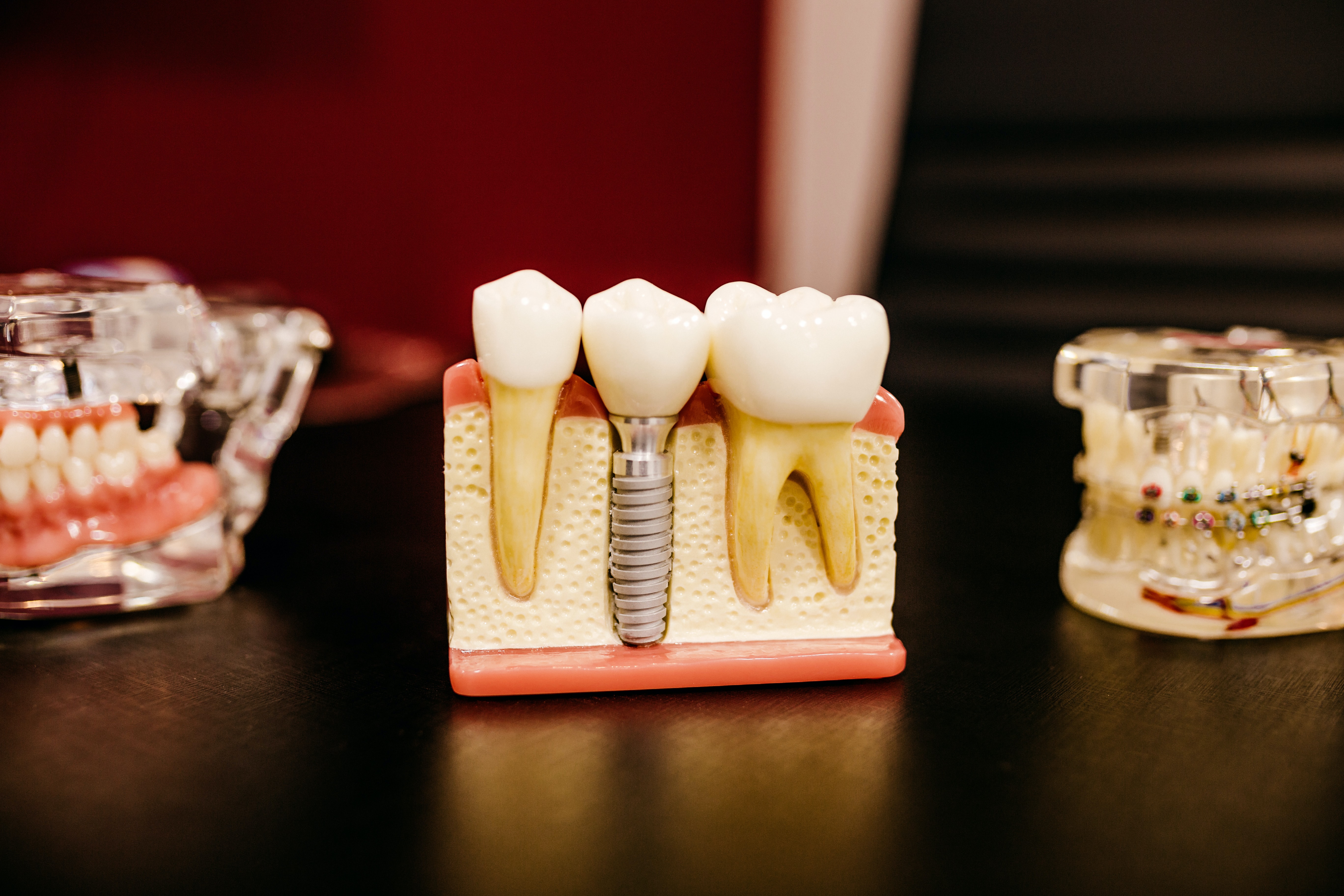 Photograph of Dental Implants model, Ann Arbor, MI