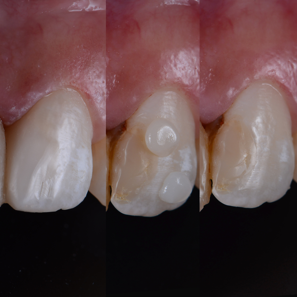 Photograph showing Tooth Colored Fillings application process, Ann Arbor, MI
